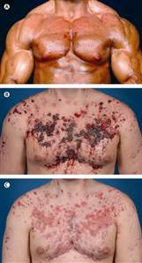 Severe acne steroids